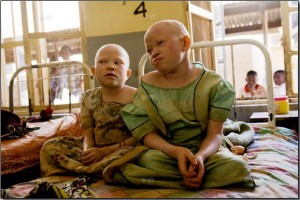 Albinos