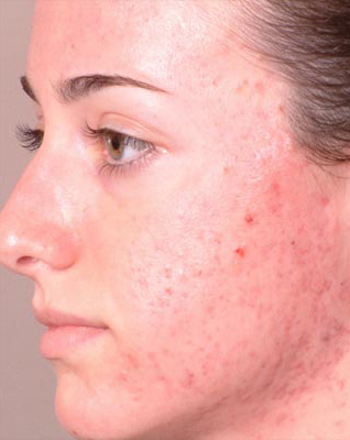 Acne :Causes and its Treatment.