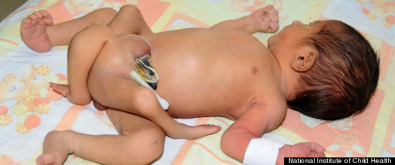 Pakistan Baby born with six legs fights for life