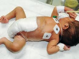 Surgeons sucessfully reduce baby’s six legs to two