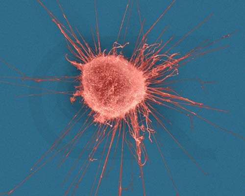 One in six cancers worldwide are caused by infection