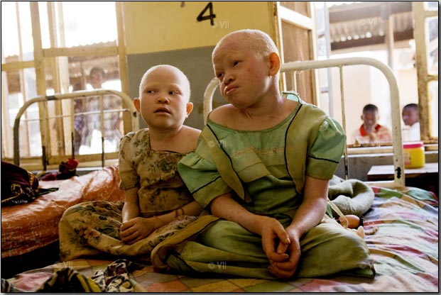 Albino Foundation Condemns Killing Of Albinos In Nigeria