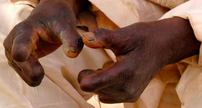 Seventeen New Cases Of Leprosy Detected In Bauchi