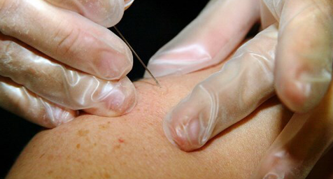 In this file photo taken on September 02, 2002 A needle makes 15 punctures in the skin through a drop of smallpox vaccine on the arm of an Israeli nurse, as laboratory workers and health personal attend a day of training in the states medical training center at the Tel Hashomer hospital in Tel Aviv.