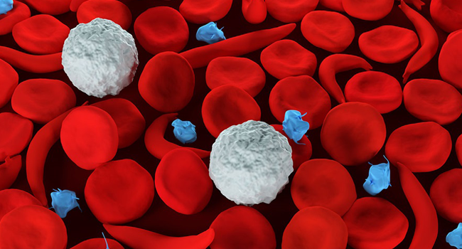 Sickle cell disease is a condition where red cells with Hemoglobin S become distorted and shaped like crescents or sickles. Credit: John Hopkins Medicine