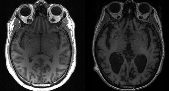 This undated image courtesy of, Dr. Timothy Rittman, University of Cambridge, shows an MRI image of a healthy brain (L) and an Alzheimer's brain (R) with large black gaps where brain has shrunk. Timothy Rittman / University of Cambridge / AFP