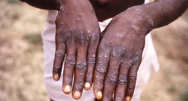 Monkeypox: ‘Too Early To Call It An Epidemic’