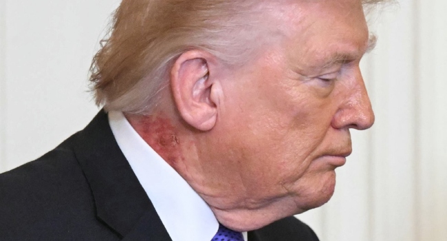 Trump Appears With Red Rash On Neck
